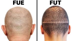 FUT FUE hair transplant abroad