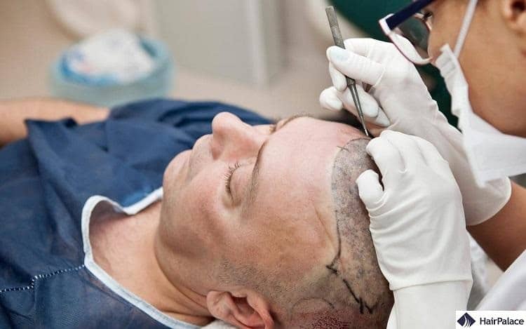 Haartransplantation im Ausland - Ungarn oder die Türkei?